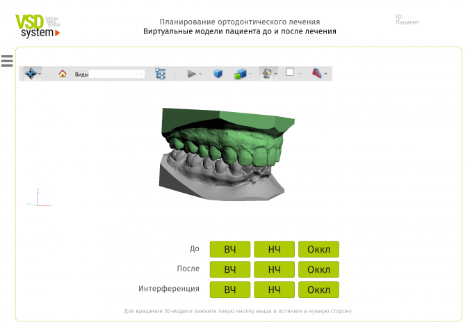 Работа с трехмерными моделями челюстей пациентов