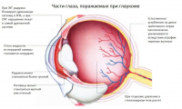 Лечение глаукомы в Израиле