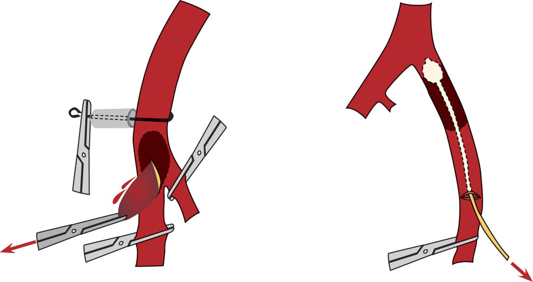 Схема операции удаления эмбола из бифуркации аорты